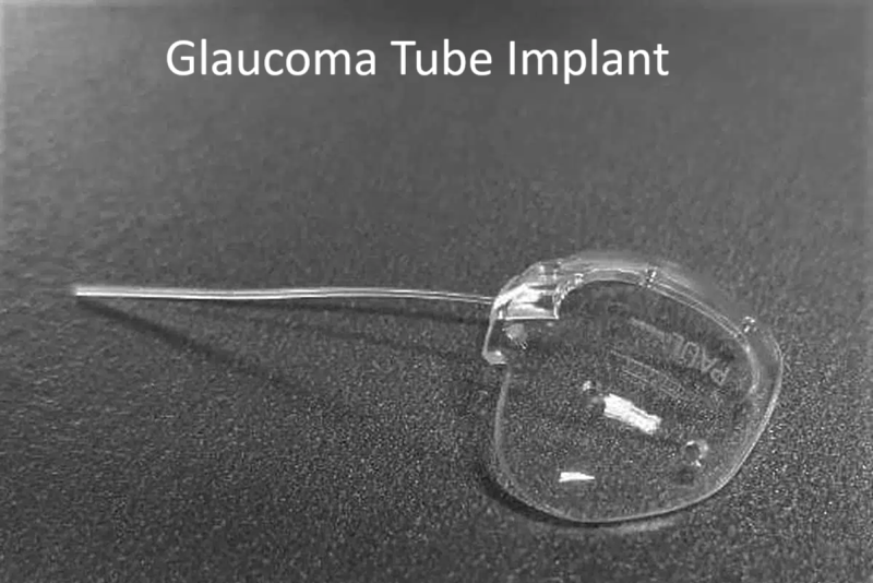 Glaucoma Tube Implant
